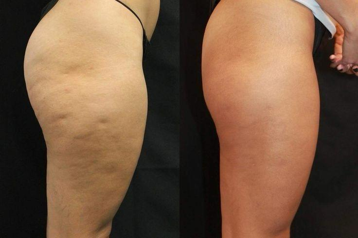 cellulite prima e dopo