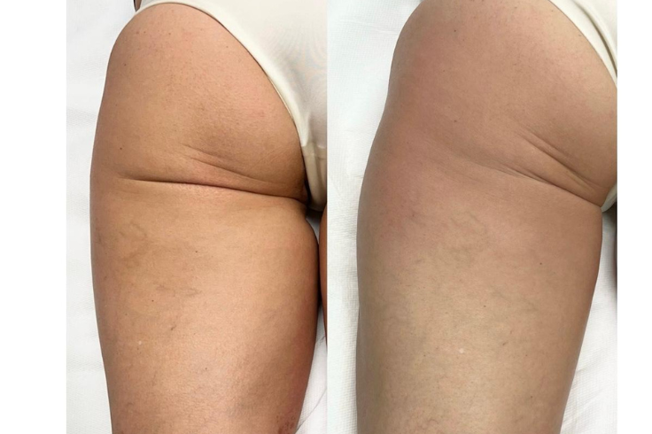 gluteo prima e dopo