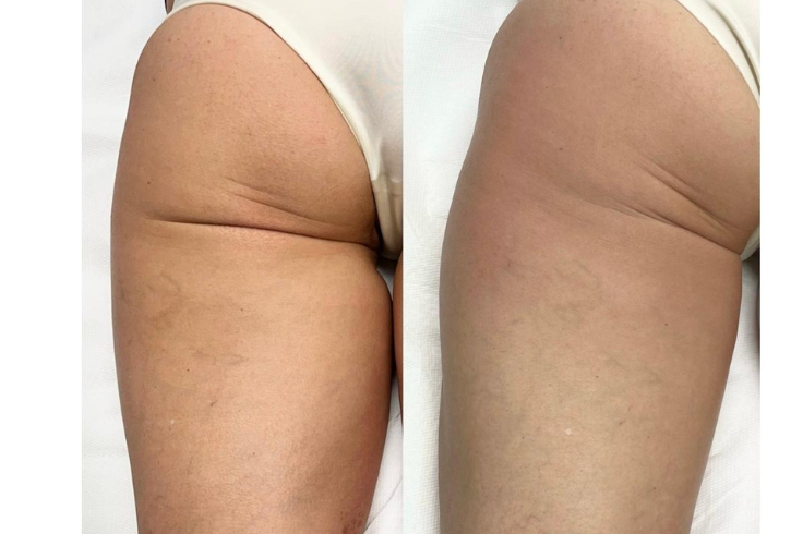 Radiofrequenza glutei